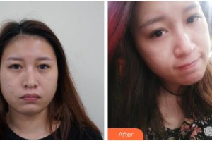 漢中韓美整形美容醫(yī)院閔慶植整形價格表附埋線提升案例展示