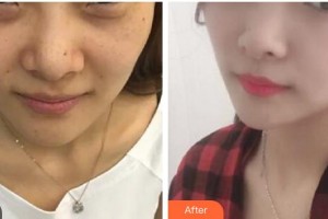 漢中天漢伊美醫(yī)療美容門診部潘會章整形價格表附埋線提升案例展示