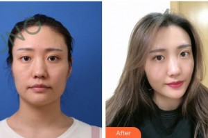 漢中祥瑞海天醫(yī)療美容診所馬嫣旎整形價格表附埋線提升案例展示