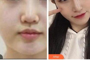 漢中祥瑞海天醫(yī)療美容診所高玉慶整形價格表附埋線提升案例展示