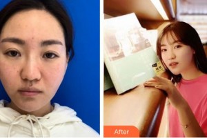 漢中職業(yè)技術學院附屬醫(yī)院眼科方彤整形價格表附埋線提升案例展示