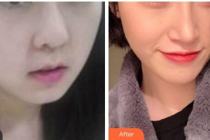 漢中天漢伊美醫(yī)療美容門診部王伶霄整形價格表附埋線提升案例展示