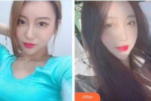 榆林婦產(chǎn)專科醫(yī)院韓式整形美容中心宋寶強(qiáng)整形價(jià)格表附切開(kāi)雙眼皮案例展示