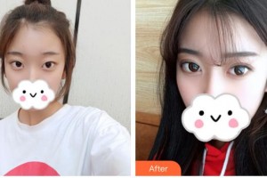 榆林醫(yī)專附屬醫(yī)院醫(yī)學(xué)整形美容中心周亞芹整形價(jià)格表附眼部綜合案例展示