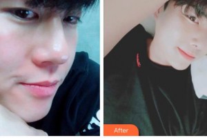 榆林愛(ài)爾眼科醫(yī)院李達(dá)整形價(jià)格表附眼部綜合案例展示