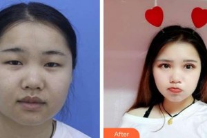 榆林市中醫(yī)醫(yī)院眼科醫(yī)院李建秀整形價(jià)格表附切開(kāi)雙眼皮案例展示