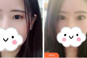 榆林市中醫(yī)醫(yī)院眼科醫(yī)院丁艷林整形價格表附眼部綜合案例展示