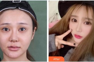 安康希顏醫(yī)療美容診所高景恒整形價格表附埋線提升案例展示