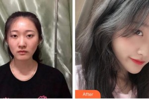 安康希顏醫(yī)療美容診所王奇整形價格表附熱瑪吉案例展示