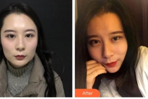 武安安康醫(yī)院整形美容中心李連貴整形價格表附埋線提升案例展示