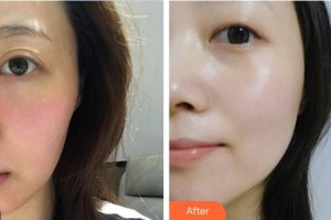 安康蝶姿醫(yī)療美容門診部慎公關整形價格表附美白導入案例展示