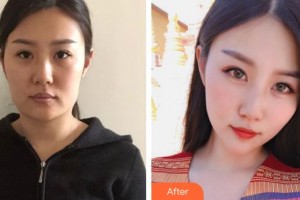 安康希顏醫(yī)療美容診所何云虎整形價格表附埋線提升案例展示