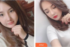 安康永秀醫(yī)療美容醫(yī)院劉祥整形價格表附埋線提升案例展示