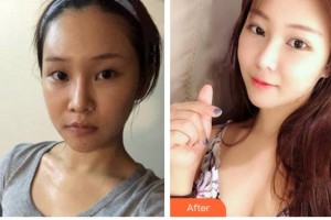 安康市人民醫(yī)院整形外科周櫻整形價格表附眼部綜合案例展示