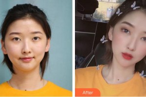 安康市人民醫(yī)院整形外科祖冬梅整形價格表附眼部綜合案例展示