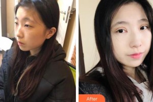 安康愛爾眼科醫(yī)院方學軍整形價格表附開內(nèi)眼角案例展示