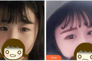 安康愛爾眼科醫(yī)院周進整形價格表附切開雙眼皮案例展示