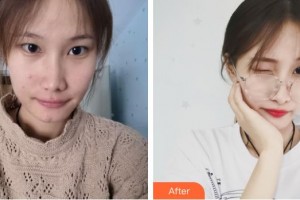 安康愛爾眼科醫(yī)院李紹偉整形價格表附眼部綜合案例展示