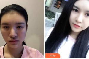 安康愛爾眼科醫(yī)院龔力力整形價格表附眼部綜合案例展示