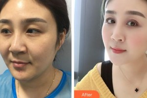 安康希顏醫(yī)療美容診所高小峰整形價格表附眼部綜合案例展示