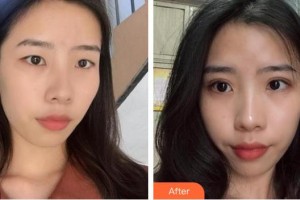 安康希顏醫(yī)療美容診所楊志榮整形價格表附埋線雙眼皮案例展示