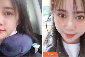 安康希顏醫(yī)療美容診所何紹其整形價(jià)格表附切開(kāi)雙眼皮案例展示