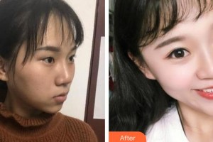 安康愛(ài)爾眼科醫(yī)院葉應(yīng)嘉整形價(jià)格表附切開(kāi)雙眼皮案例展示