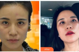 安康愛(ài)爾眼科醫(yī)院譚中信整形價(jià)格表附激光去眼袋案例展示