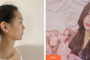 慶陽博愛整形醫(yī)院張恩榮整形價格表附切開雙眼皮案例展示