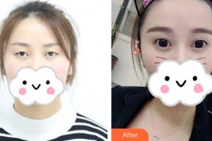 慶陽華美醫(yī)療美容診所田輝整形價格表附眼部綜合案例展示