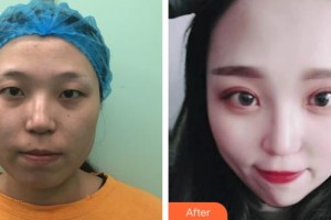 慶陽美立方醫(yī)學(xué)美容診所李智勇整形價格表附眼部綜合案例展示