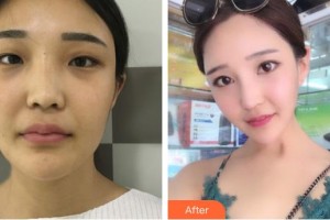 天水瑪莉亞（原女子）醫(yī)院醫(yī)學整形中心徐明整形價格表附鼻部綜合案例展示