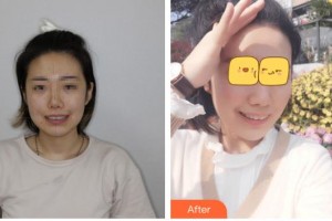 天水瑪莉亞（原女子）醫(yī)院醫(yī)學整形中心郭莉整形價格表附牙齒隱形矯正案例展示