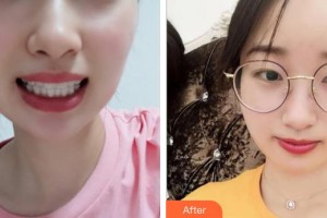 天水市中西醫(yī)結合醫(yī)院口腔頜面外科宋元元整形價格表附牙齒隱形矯正案例展示