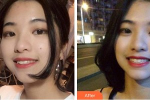 天水市中西醫(yī)結合醫(yī)院口腔頜面外科賈雙琴整形價格表附牙齒隱形矯正案例展示