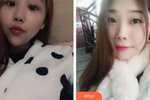 天水市中西醫(yī)結合醫(yī)院口腔頜面外科趙瓊整形價格表附自鎖托槽矯正案例展示