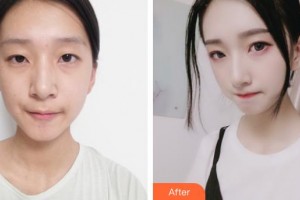 天水韓美整形美容門診部牛江艷整形價格表附埋線提升案例展示