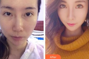 天水韓美整形美容門診部閆相友整形價格表附埋線提升案例展示