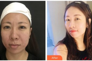 銀川慧頂醫(yī)學(xué)美容診所唐玉琴整形價(jià)格表附埋線提升案例展示