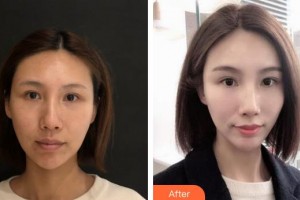 銀川靚鑫醫(yī)療美容診所張自強(qiáng)整形價(jià)格表附埋線提升案例展示