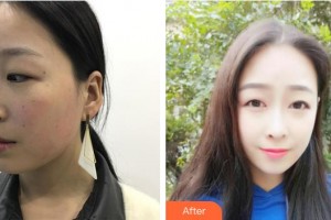 銀川百思美醫(yī)療美容診所陳永整形價(jià)格表附埋線提升案例展示