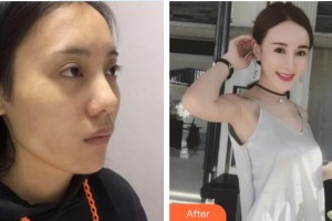 銀川愛美麗醫(yī)療美容門診部邢懷華整形價(jià)格表附埋線提升案例展示