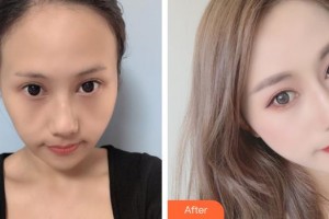 銀川維多利亞醫(yī)療美容醫(yī)院吳濤整形價格表附埋線提升案例展示