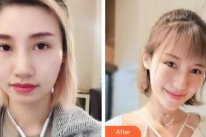 銀川維多利亞醫(yī)療美容醫(yī)院張志國整形價格表附埋線提升案例展示