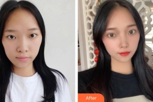 義烏愛爾眼科醫(yī)院陳曉華整形價(jià)格表附眼部綜合案例展示