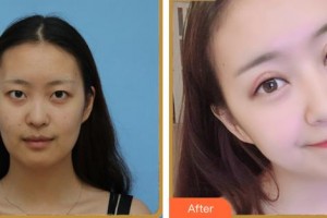 義烏愛爾眼科醫(yī)院戴襄軍整形價(jià)格表附眼部綜合案例展示