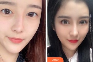 義烏視光眼科醫(yī)院楊衛(wèi)志整形價(jià)格表附眼部修復(fù)案例展示