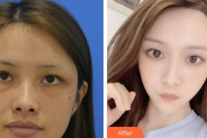 義烏視光眼科醫(yī)院杜爾罡整形價(jià)格表附眼部綜合案例展示