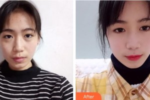 商洛中醫(yī)醫(yī)院燒傷整形科李寬民整形價(jià)格表附切開(kāi)雙眼皮案例展示