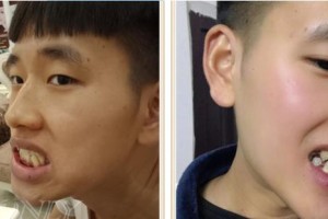 商洛市婦幼保健院口腔科李三軍整形價(jià)格表附金屬托槽矯正案例展示